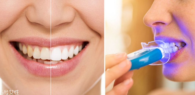 牙齒美白能保持多久？牙齒美白方法有哪些？
