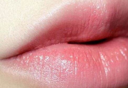 厚唇變薄術會反彈嗎？厚唇變薄術的真實經歷