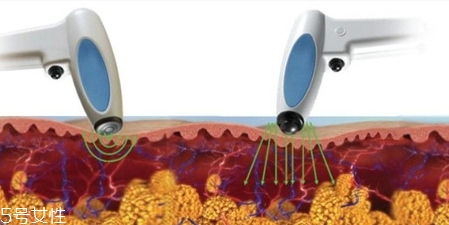 射頻溶脂效果怎么樣？射頻溶脂風(fēng)險(xiǎn)大嗎