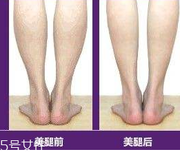 瘦小腿手術價格多少 瘦小腿手術很貴嗎