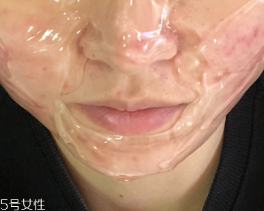 紅藍(lán)光治痤瘡需要幾次 紅藍(lán)光治痤瘡幾個療程能痊愈