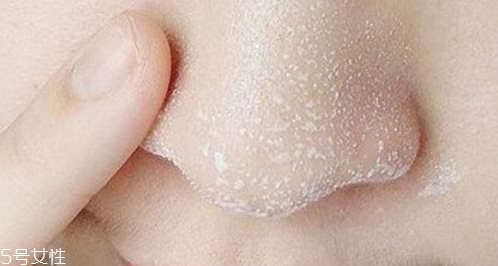 黑頭不管它會變大嗎？黑頭不管它會怎樣？