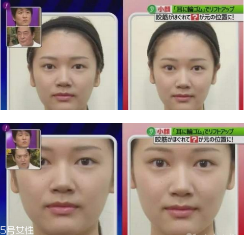 橡皮筋綁耳朵每天用嗎 橡皮筋綁耳朵瘦臉法操作方法 橡皮筋綁耳朵每天用嗎 橡皮筋綁耳朵瘦臉法操作方法