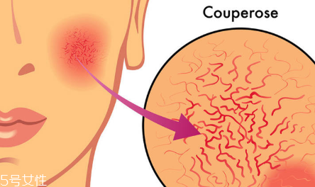 敏感肌膚用什么精油好 低濃度精油保養(yǎng)大法 敏感肌膚用什么精油好 低濃度精油保養(yǎng)大法