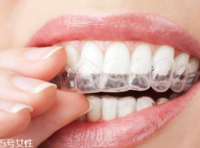 牙齒矯正器優(yōu)缺點(diǎn) 改變的不只是牙 牙齒矯正器優(yōu)缺點(diǎn) 改變的不只是牙