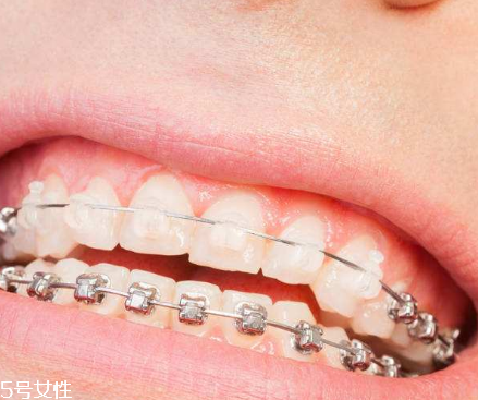 牙齒矯正器優(yōu)缺點(diǎn) 改變的不只是牙 牙齒矯正器優(yōu)缺點(diǎn) 改變的不只是牙