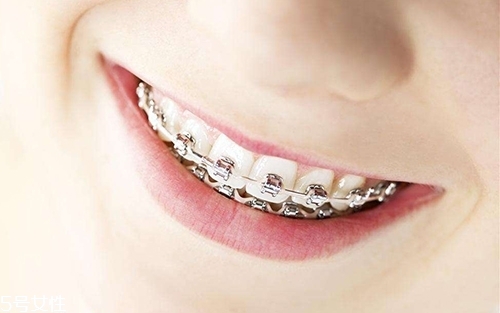 牙齒矯正器優(yōu)缺點(diǎn) 改變的不只是牙 牙齒矯正器優(yōu)缺點(diǎn) 改變的不只是牙
