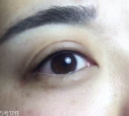 美瞳線會(huì)腫幾天 不超過(guò)一周