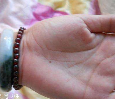 點(diǎn)痣能喝可樂(lè)嗎 這個(gè)可以喝 點(diǎn)痣能喝可樂(lè)嗎 這個(gè)可以喝