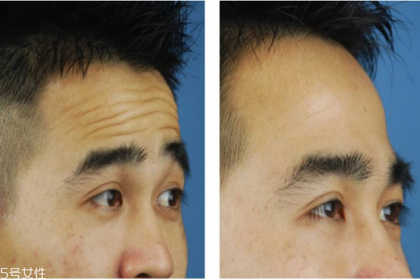 抬頭紋怎么去除？小妙招教給你