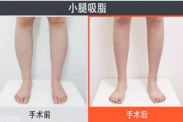 小腿吸脂后遺癥你知道多少？