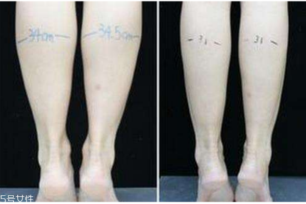 小腿吸脂后遺癥你知道多少？