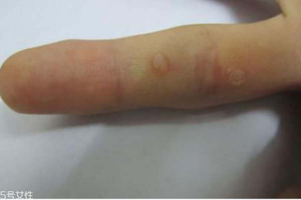 手上長(zhǎng)了個(gè)硬疙瘩怎么回事 手上長(zhǎng)了個(gè)硬疙瘩像繭