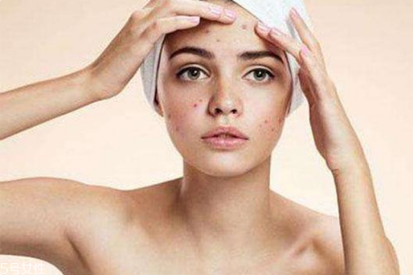 痘痘肌怎么護理 痘痘肌護理誤區(qū) 痘痘肌怎么護理 痘痘肌護理誤區(qū)