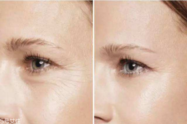 激光魚(yú)尾紋多少錢呢 激光去魚(yú)尾紋的價(jià)格