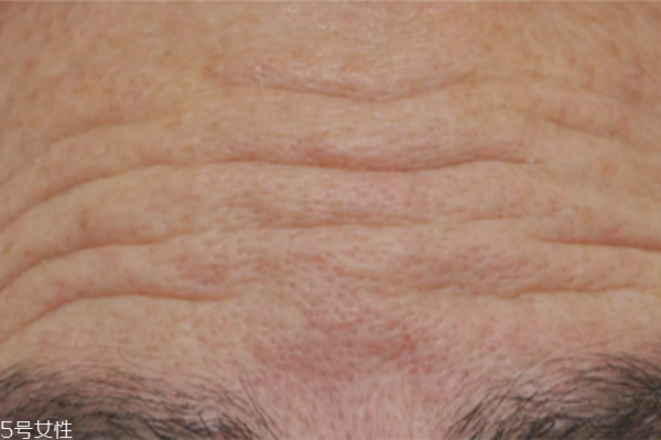 抬頭紋除皺針多久生效 抬頭紋除皺針注意事項 抬頭紋除皺針多久生效 抬頭紋除皺針注意事項