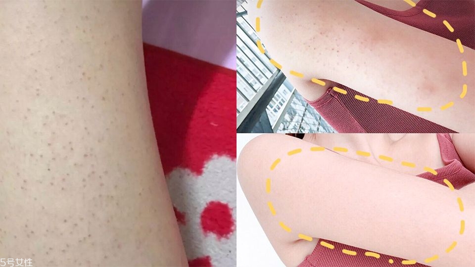 毛孔角化癥怎么治 4款專治身體乳推薦 毛孔角化癥怎么治 4款專治身體乳推薦