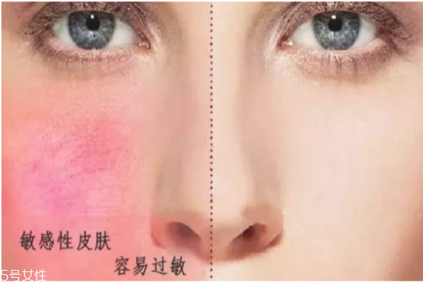怎么判斷自己什么膚質(zhì) 油皮應該如何護膚