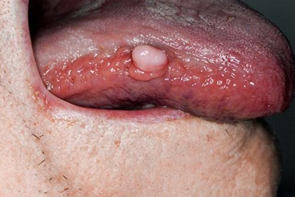 中醫(yī)教你從舌頭上看身體是否有疾病 中醫(yī)教你從舌頭上看身體是否有疾病