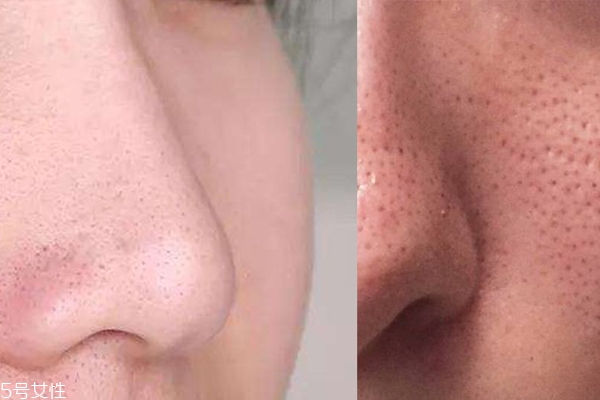 油性皮膚毛孔怎么縮小 3個(gè)步驟養(yǎng)出無(wú)瑕陶瓷肌 油性皮膚毛孔怎么縮小 3個(gè)步驟養(yǎng)出無(wú)瑕陶瓷肌