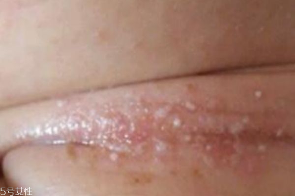 淹脖子是什么 怎么預防