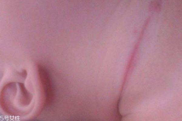 淹脖子是什么 怎么預防