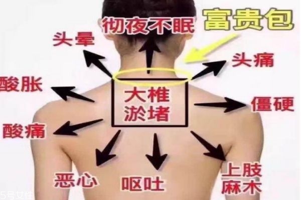 富貴包會(huì)引起什么病 教你如何預(yù)防 富貴包會(huì)引起什么病 教你如何預(yù)防