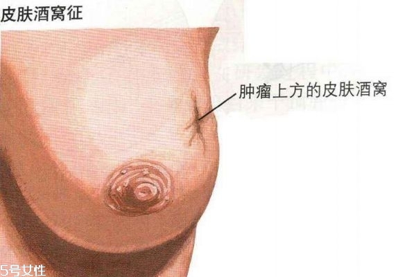 乳腺癌的早期癥狀 帶你認(rèn)識乳腺癌
