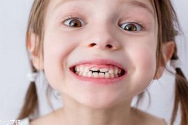 牙縫大怎么修復(fù) 為什么牙縫會越來越大 牙縫大怎么修復(fù) 為什么牙縫會越來越大