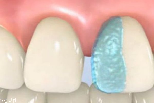 牙縫大怎么修復(fù) 為什么牙縫會越來越大 牙縫大怎么修復(fù) 為什么牙縫會越來越大