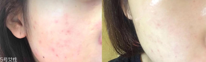 2019醫(yī)美面膜哪個(gè)牌子好 5大熱門醫(yī)美面膜pk