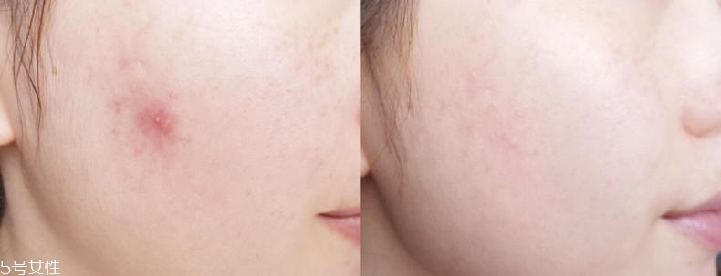 2019醫(yī)美面膜哪個(gè)牌子好 5大熱門醫(yī)美面膜pk