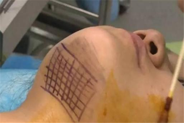 雙下巴可以做線雕嗎 有收緊作用 雙下巴可以做線雕嗎 有收緊作用