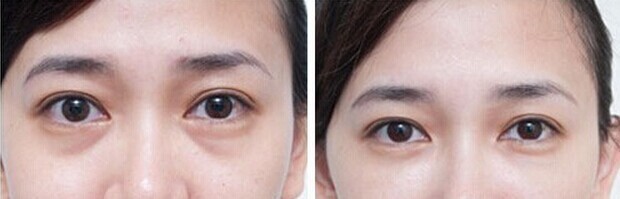 淚溝能自己恢復(fù)嗎？淚溝怎么自己恢復(fù)？