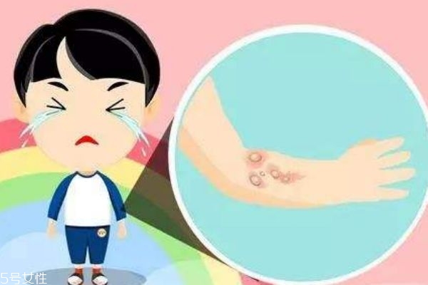 燙傷后起水泡怎么處理 燙傷后起水泡多久能好 燙傷后起水泡怎么處理 燙傷后起水泡多久能好