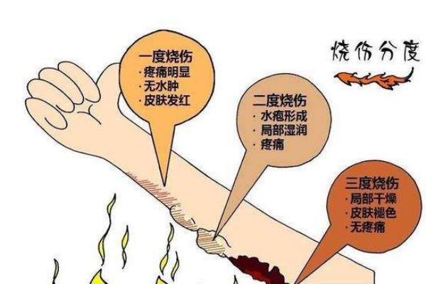 燙傷后起水泡怎么處理 燙傷后起水泡多久能好 燙傷后起水泡怎么處理 燙傷后起水泡多久能好