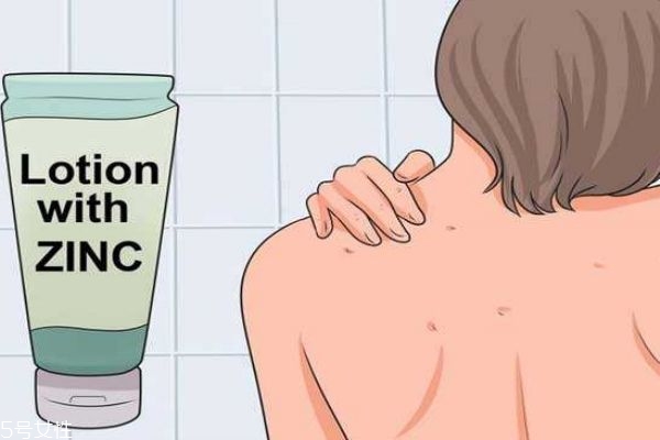 為什么背部會(huì)長(zhǎng)痘痘 后背痘痘怎么快速去除