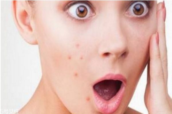 熬夜起痘痘能擠嗎 熬夜痘痘去除方法 熬夜起痘痘能擠嗎 熬夜痘痘去除方法