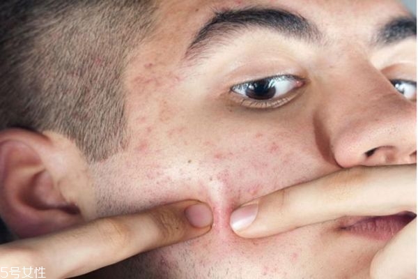 為什么熬夜會(huì)長痘 怎樣防止熬夜起痘痘