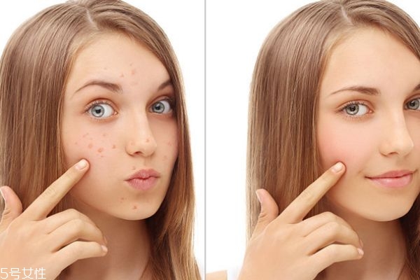 美白祛斑有哪些小竅門(mén) 美白祛斑小竅門(mén)