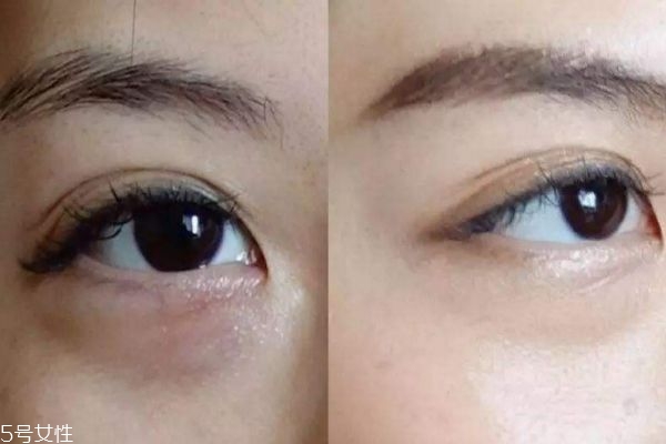 眼袋內切好還是外切好 去眼袋內切和外切區(qū)別
