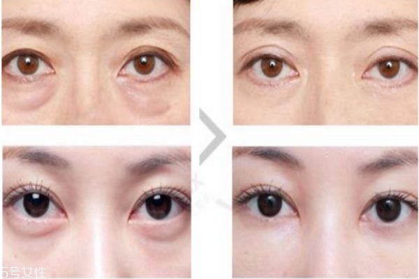 眼袋內切好還是外切好 去眼袋內切和外切區(qū)別