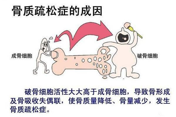 骨質疏松吃什么好 骨質疏松食譜