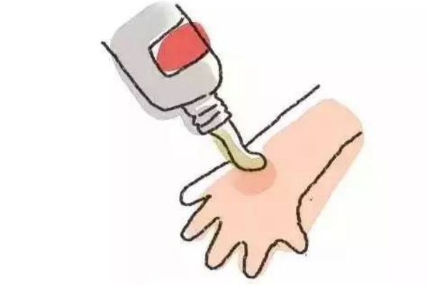 燙傷后的水泡能挑破嗎 怎樣挑破水泡才不容易引起感染 燙傷后的水泡能挑破嗎 怎樣挑破水泡才不容易引起感染