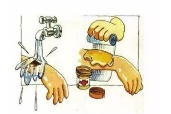 燙傷后的水泡能挑破嗎 怎樣挑破水泡才不容易引起感染 燙傷后的水泡能挑破嗎 怎樣挑破水泡才不容易引起感染