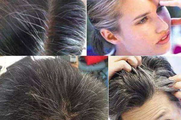 白頭發(fā)可以拔嗎 白頭發(fā)解決方法 白頭發(fā)可以拔嗎 白頭發(fā)解決方法