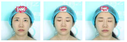 開(kāi)內(nèi)眼角要多久恢復(fù) 依個(gè)人體質(zhì)而定