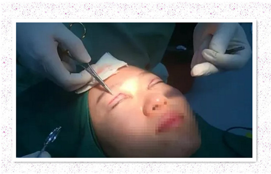 開(kāi)內(nèi)眼角要多久恢復(fù) 依個(gè)人體質(zhì)而定