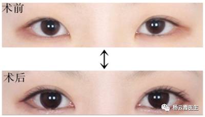 開內(nèi)眼角要多少錢 各地區(qū)不統(tǒng)一 開內(nèi)眼角要多少錢 各地區(qū)不統(tǒng)一