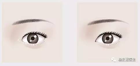 開內(nèi)眼角要多少錢 各地區(qū)不統(tǒng)一 開內(nèi)眼角要多少錢 各地區(qū)不統(tǒng)一